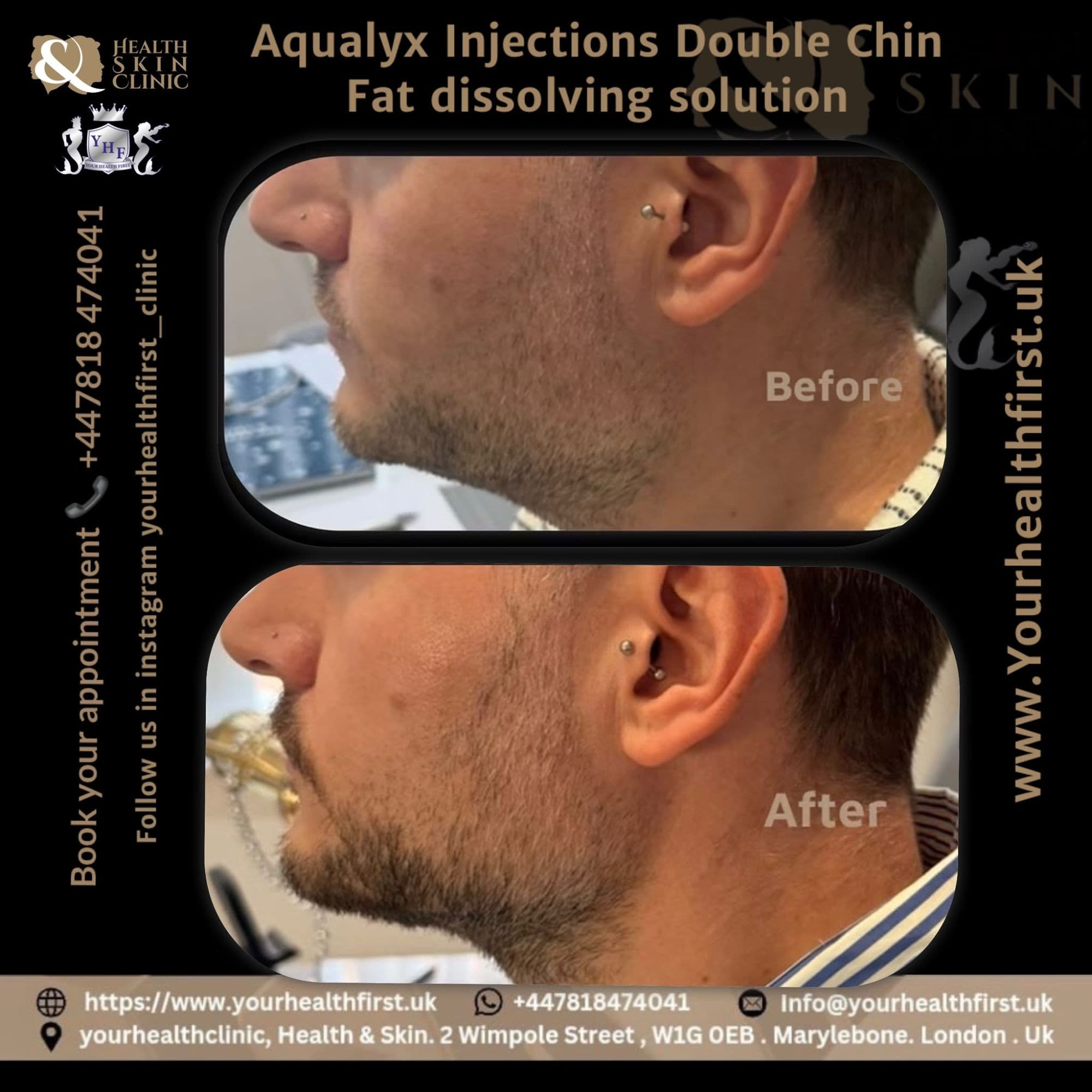 Aqualyx (Fat Dissolving) before & after — result 1