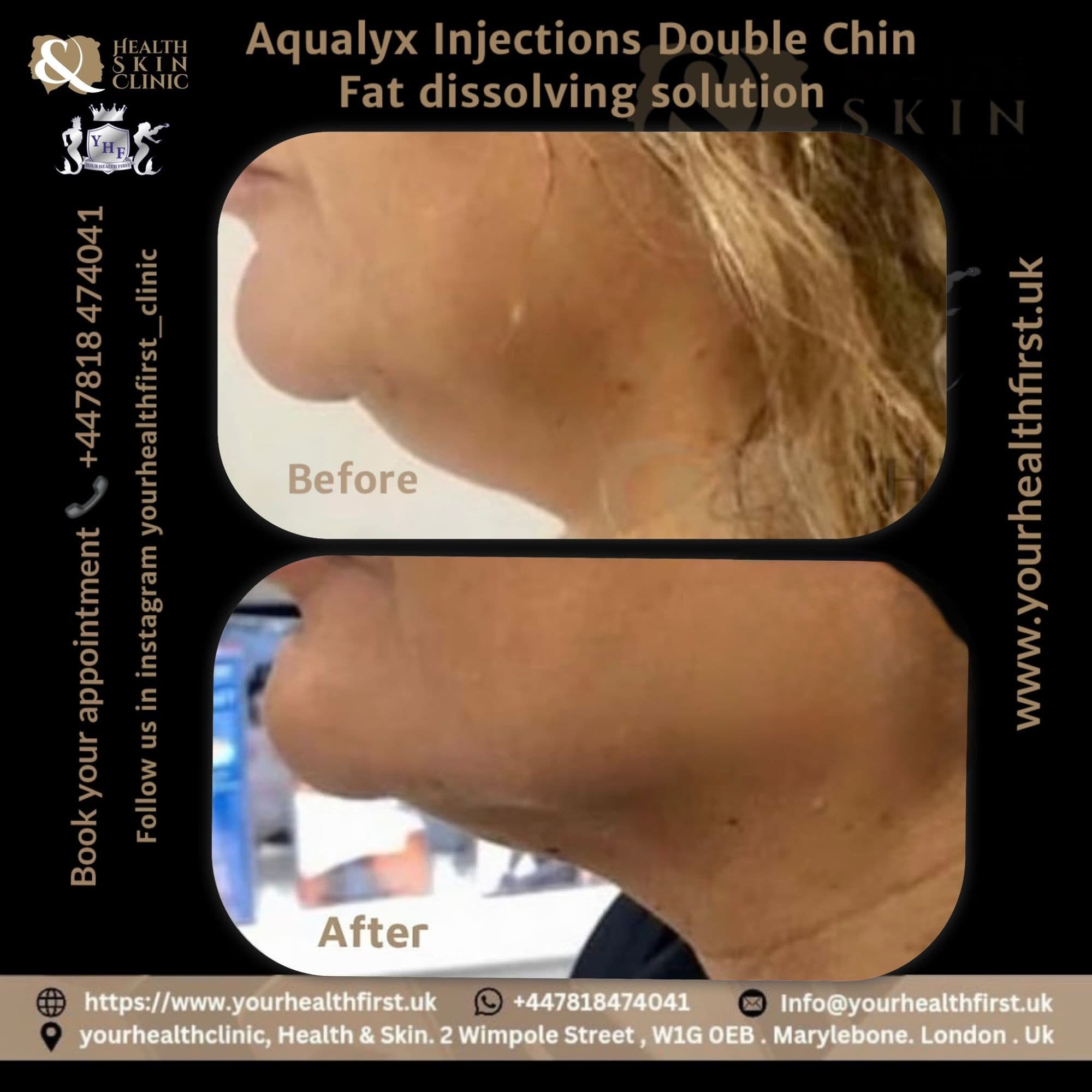 Aqualyx (Fat Dissolving) before & after — result 2
