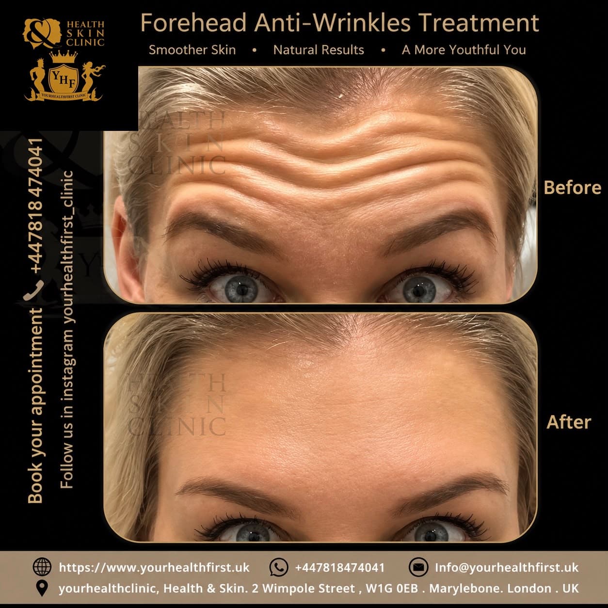 Anti-wrinkle (Botox) before & after — result 10