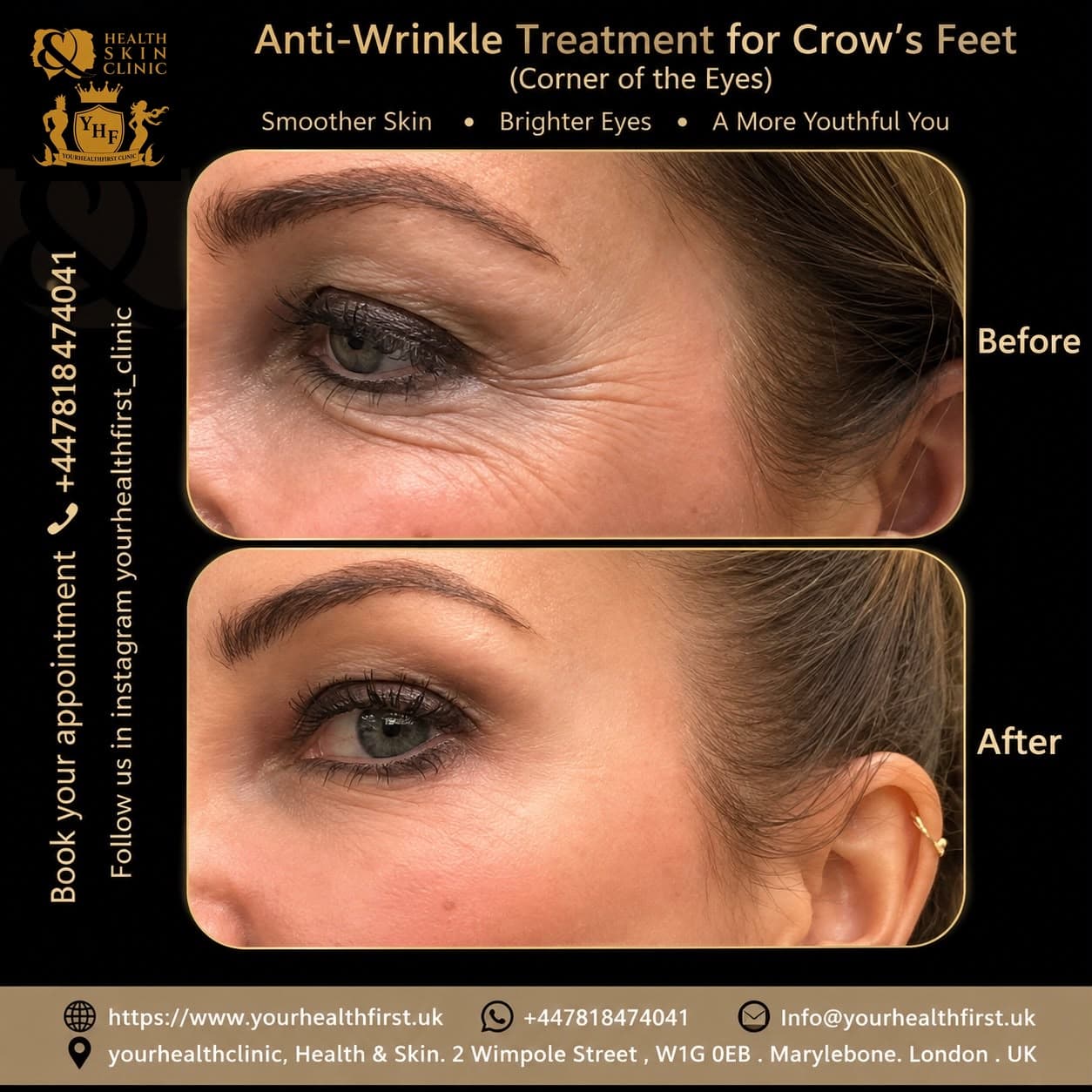 Anti-wrinkle (Botox) before & after — result 11