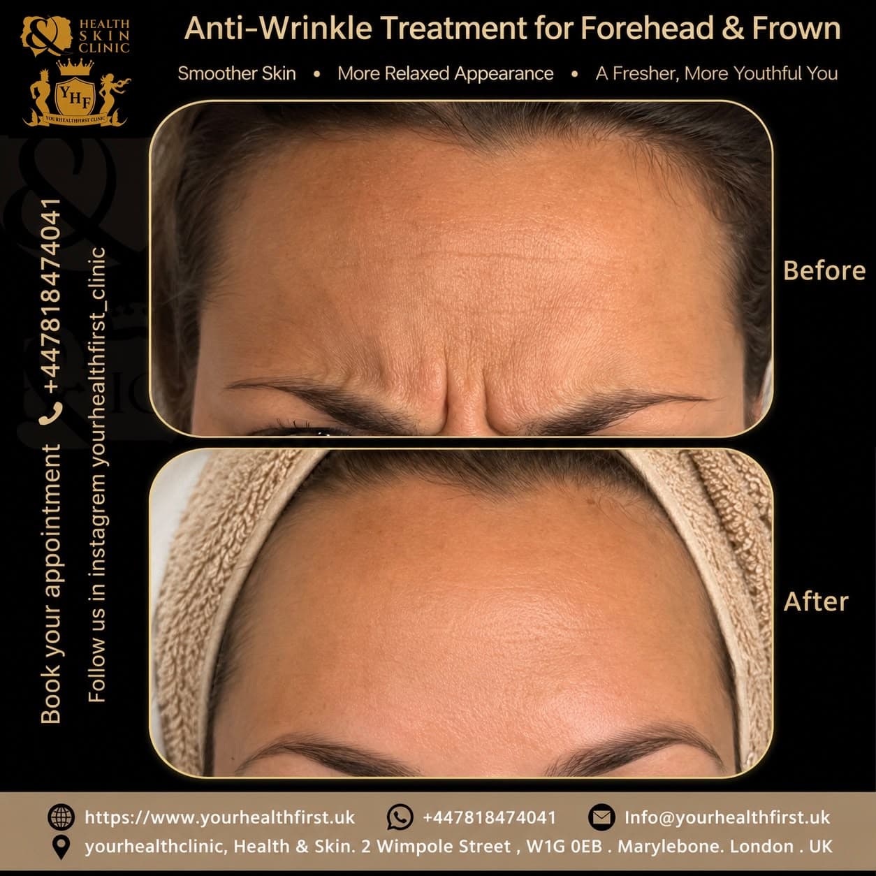 Anti-wrinkle (Botox) before & after — result 12