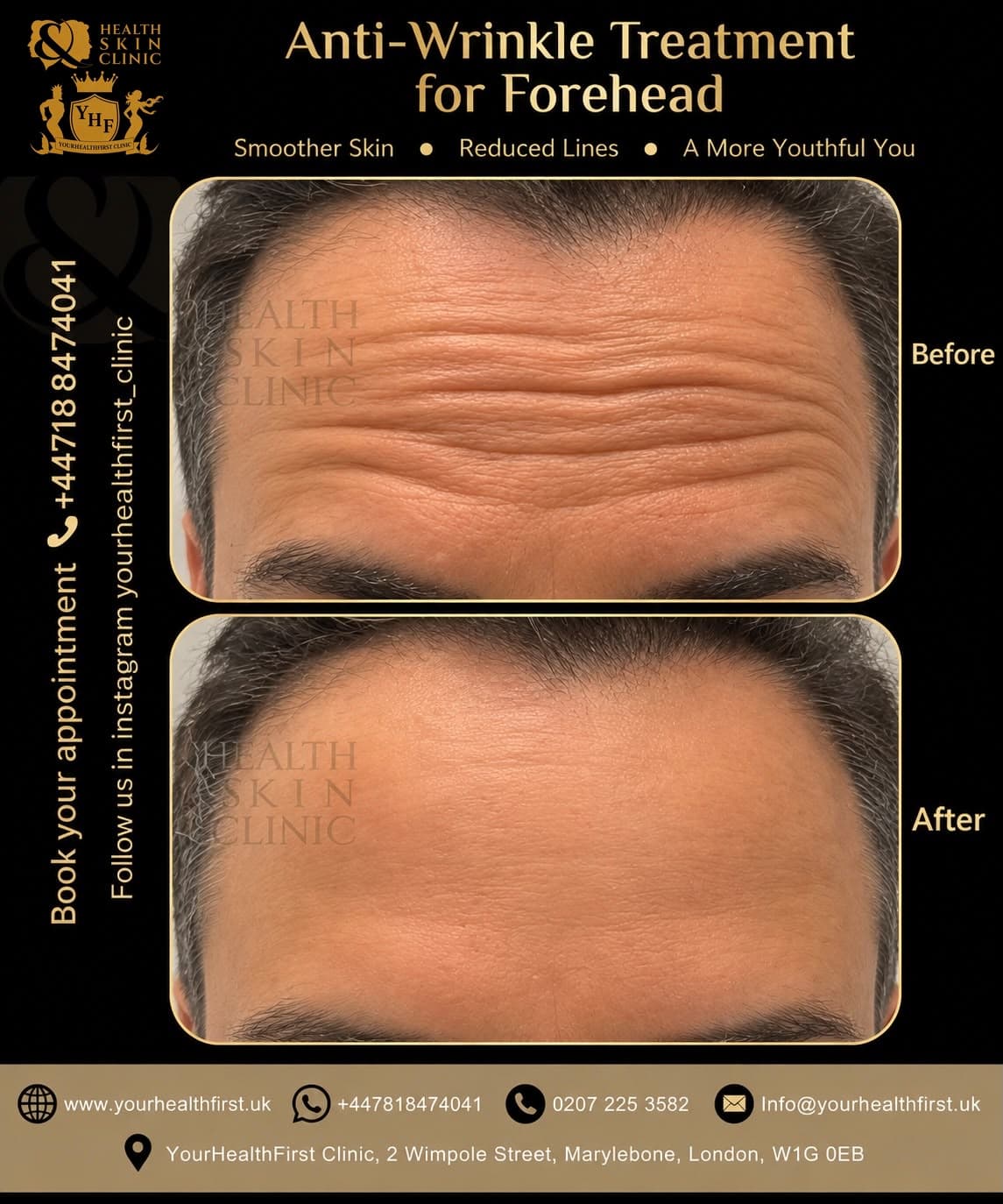 Anti-wrinkle (Botox) before & after — result 13