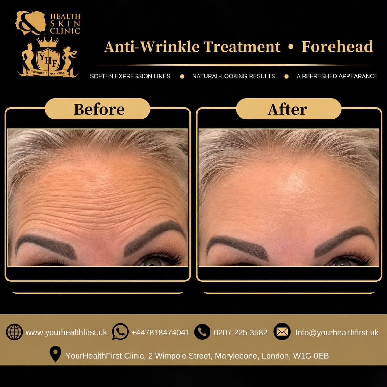 Anti-wrinkle (Botox) before & after — result 14
