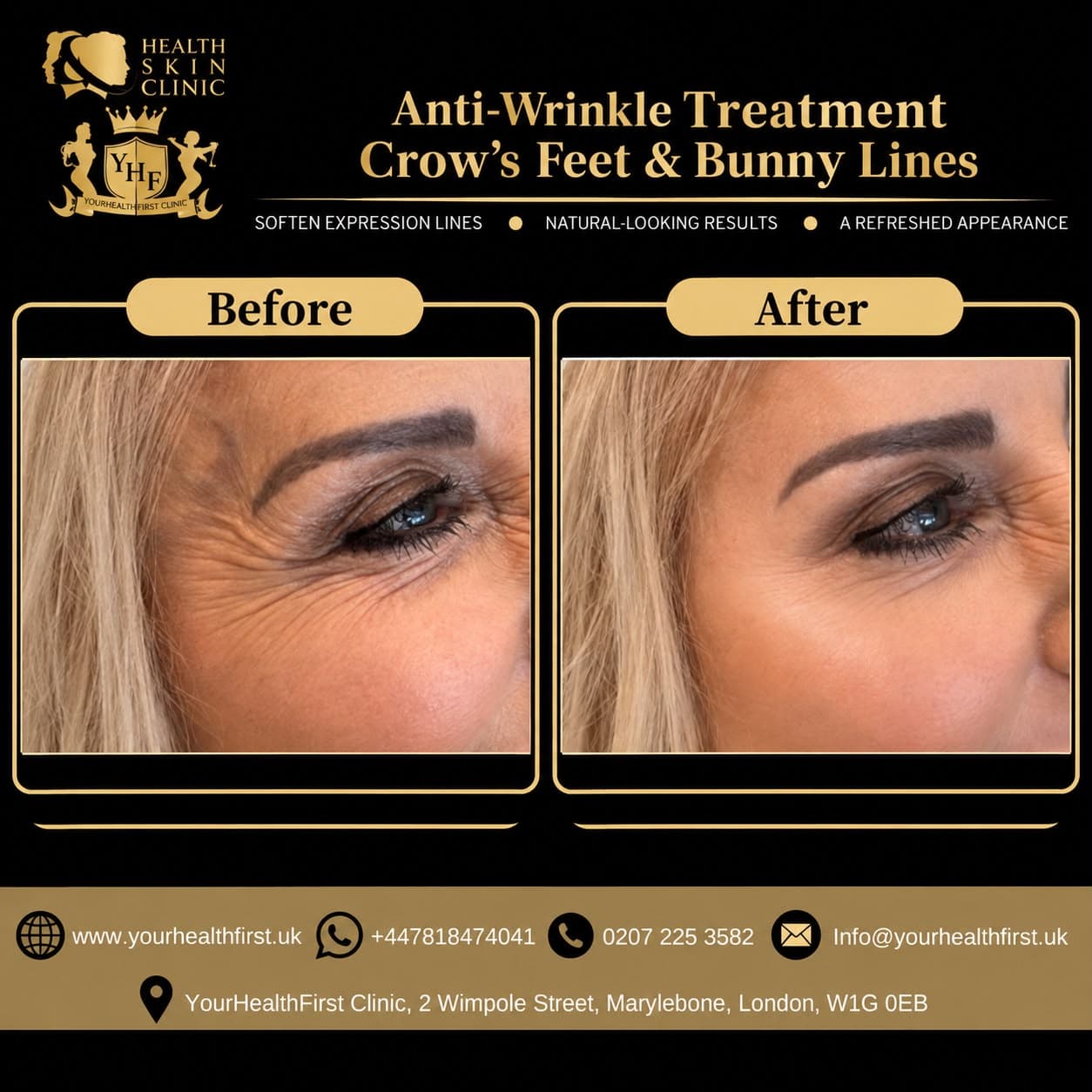 Anti-wrinkle (Botox) before & after — result 4