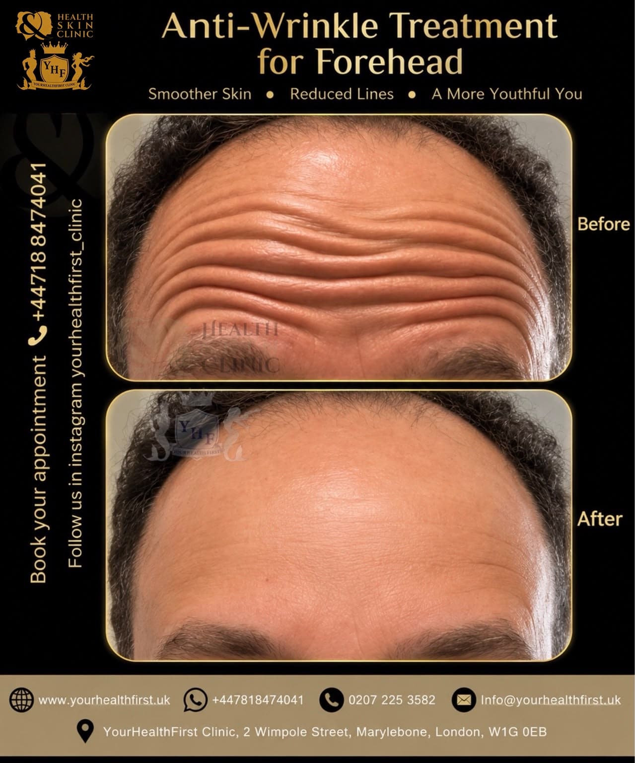 Anti-wrinkle (Botox) before & after — result 5