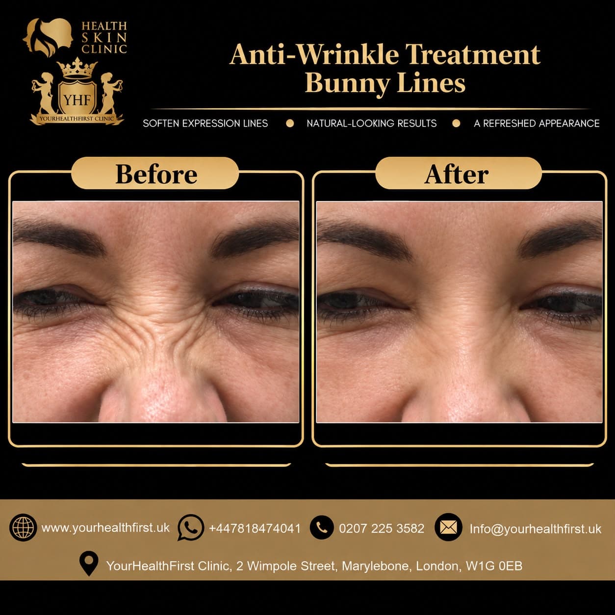Anti-wrinkle (Botox) before & after — result 6