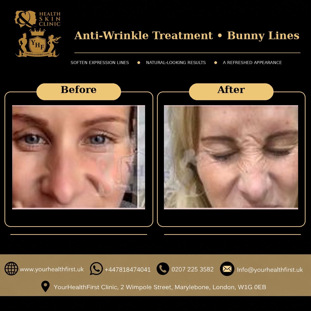Anti-wrinkle (Botox) before & after — result 7