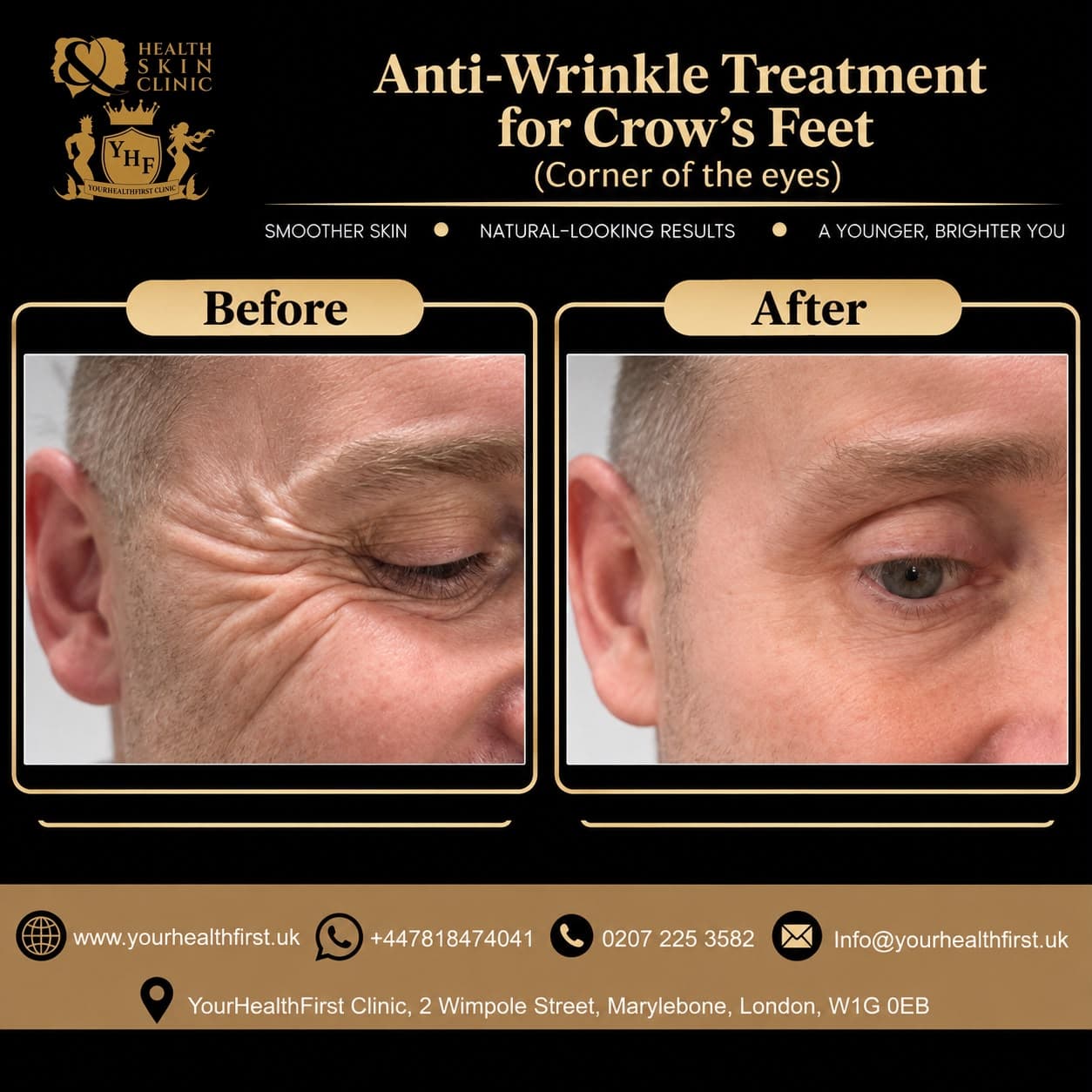 Anti-wrinkle (Botox) before & after — result 8