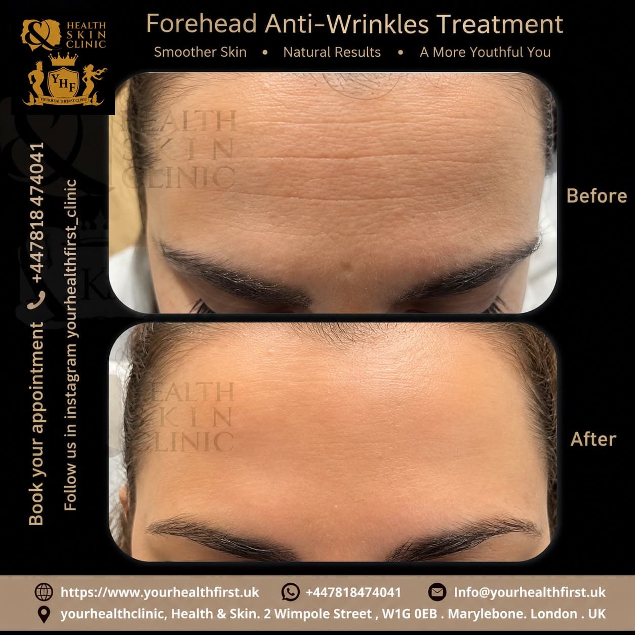 Anti-wrinkle (Botox) before & after — result 9