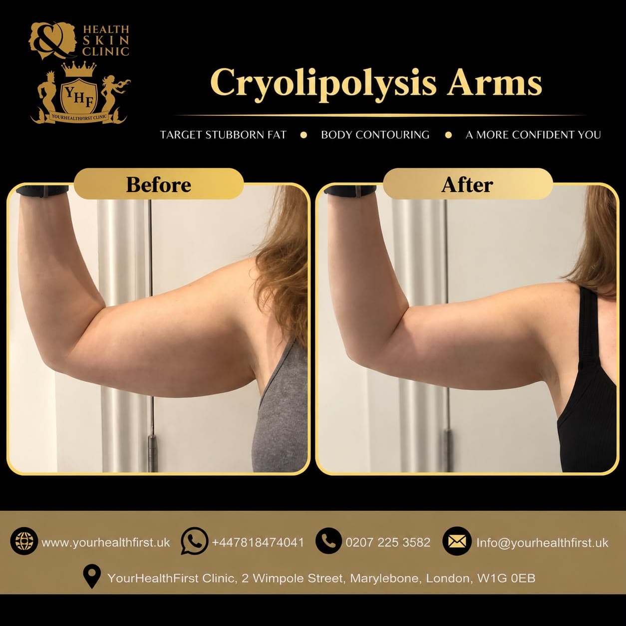 Cryolipolysis before & after — result 10