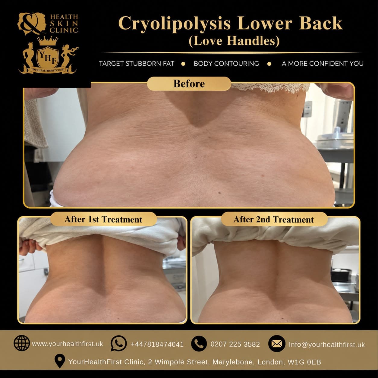 Cryolipolysis before & after — result 11