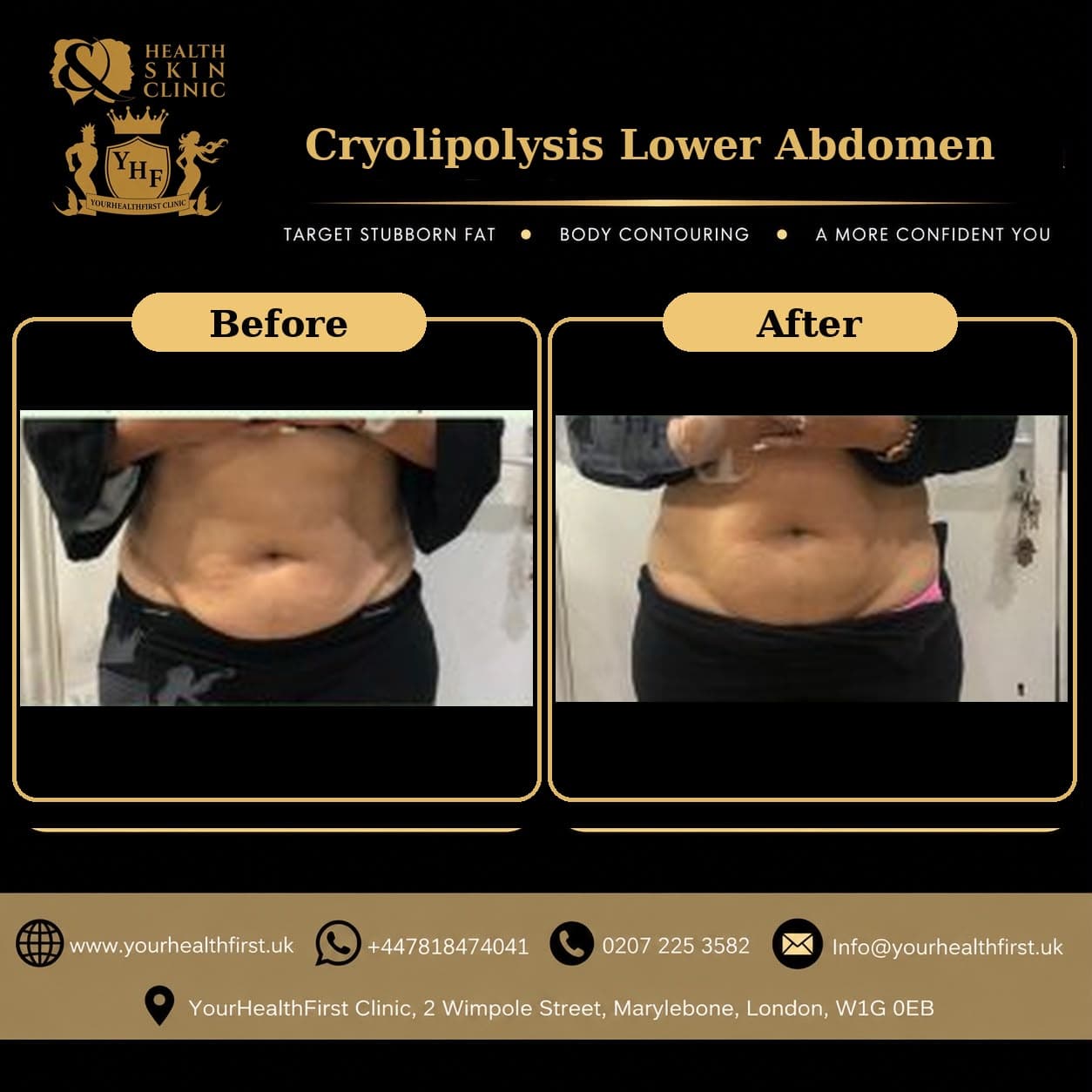 Cryolipolysis before & after — result 12