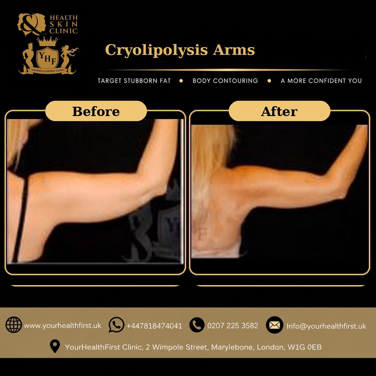 Cryolipolysis before & after — result 13