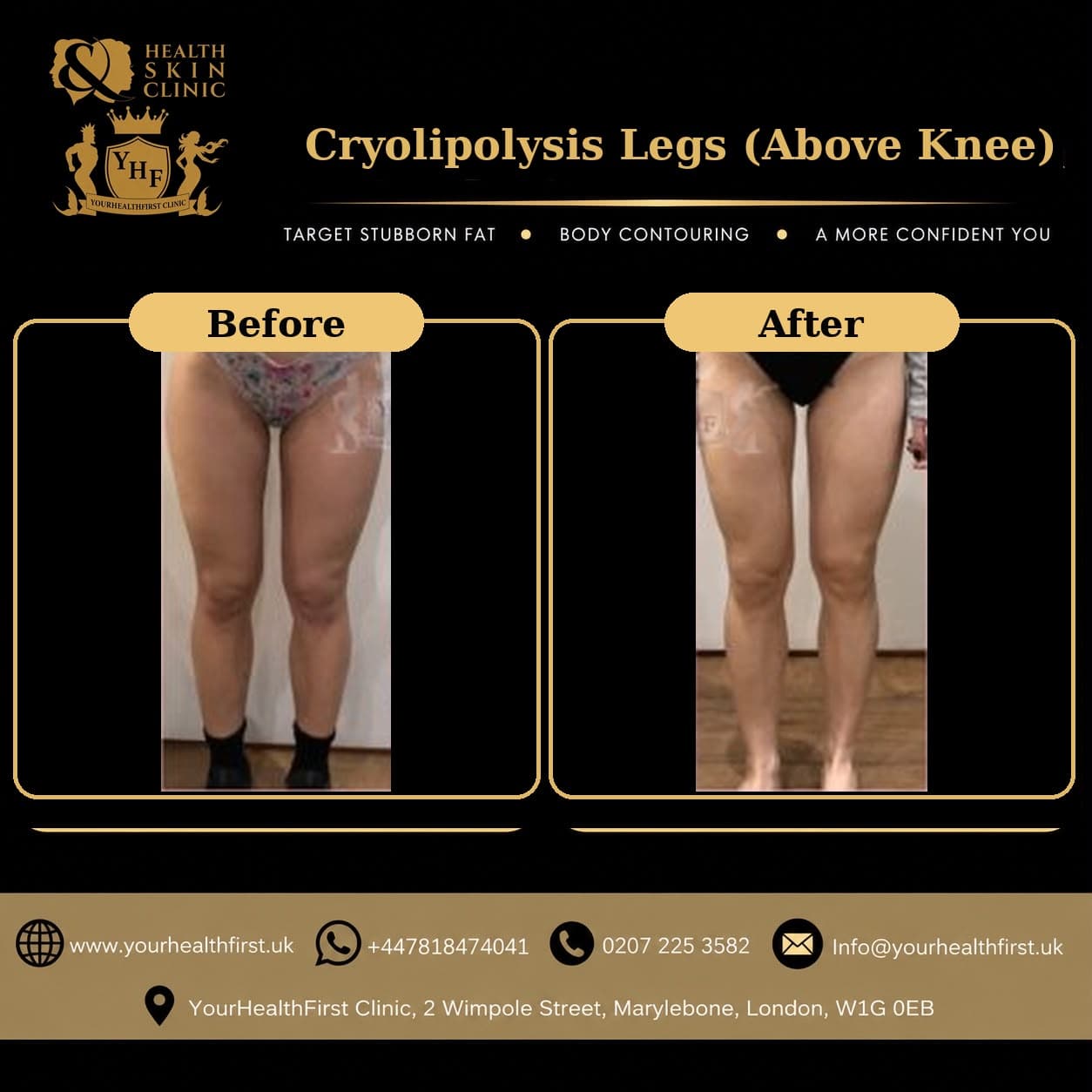 Cryolipolysis before & after — result 14