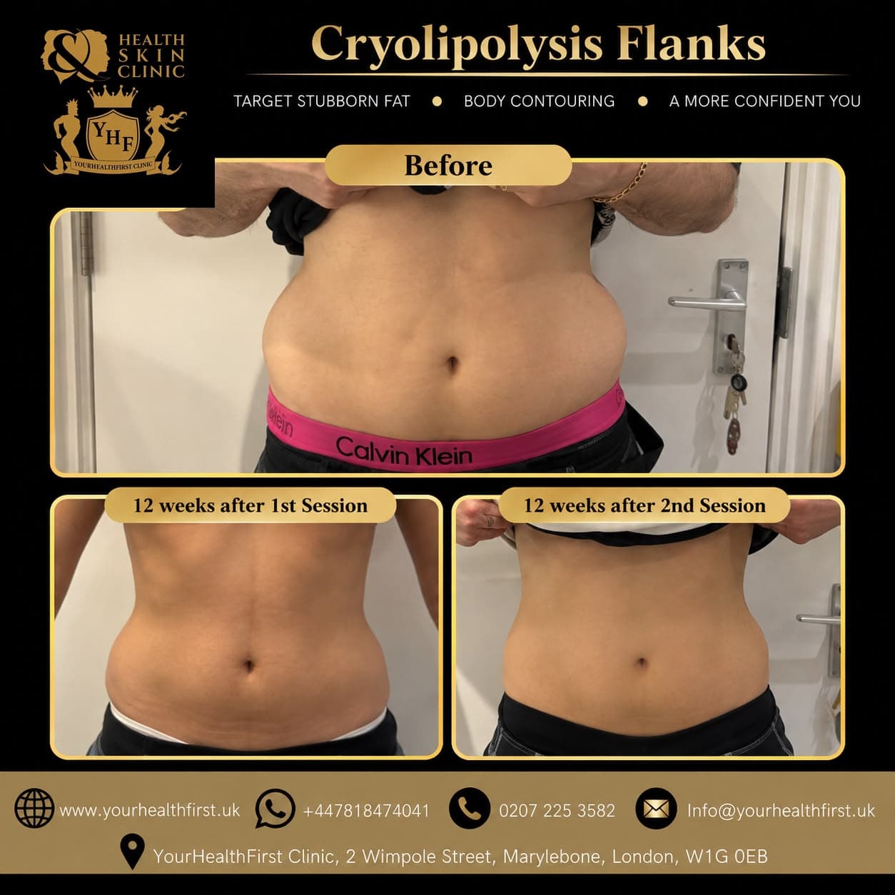 Cryolipolysis before & after — result 15