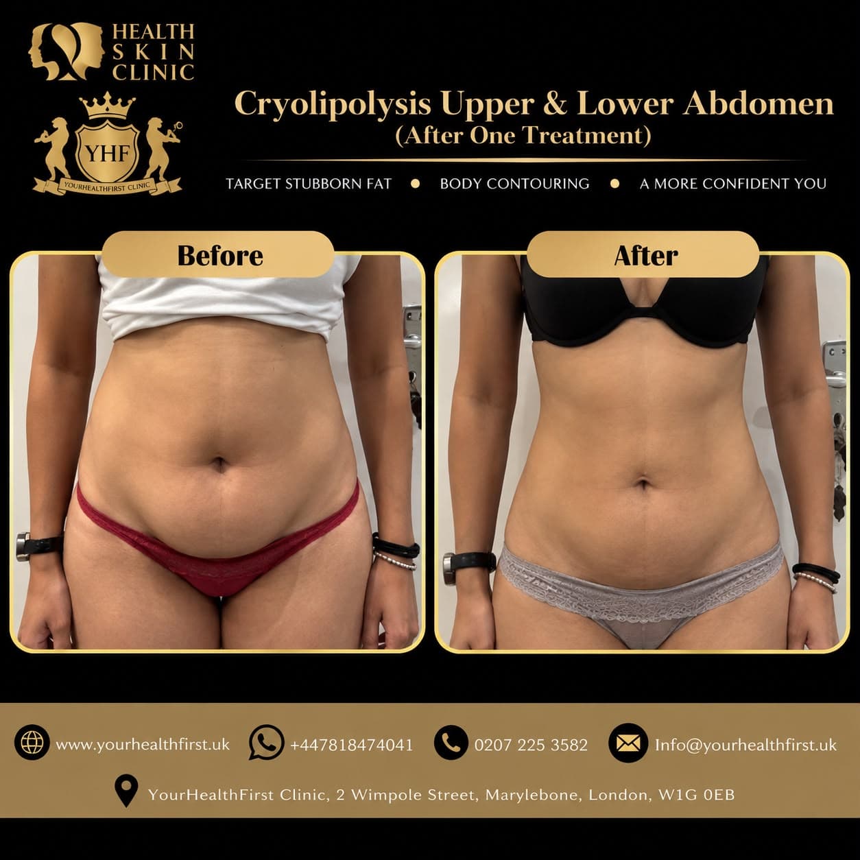 Cryolipolysis before & after — result 16