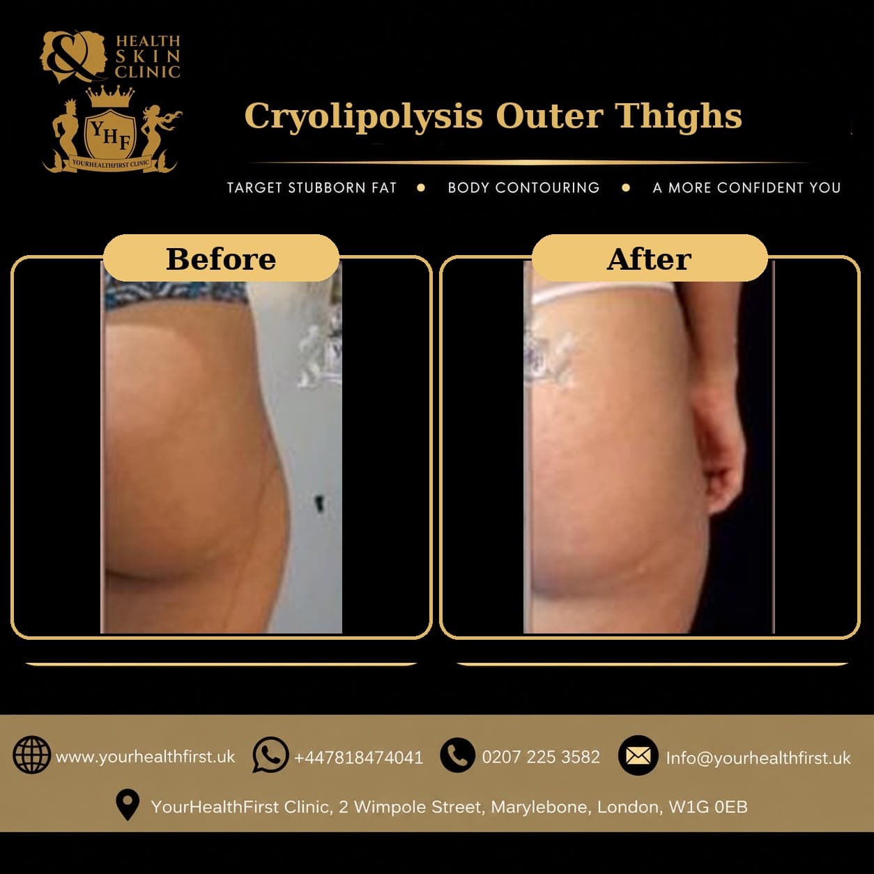 Cryolipolysis before & after — result 17