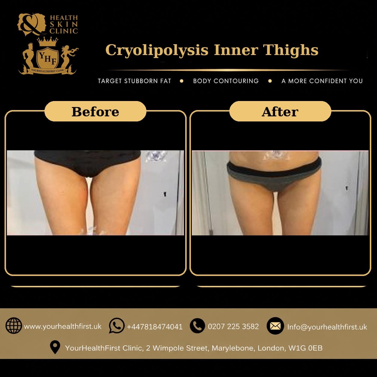 Cryolipolysis before & after — result 18