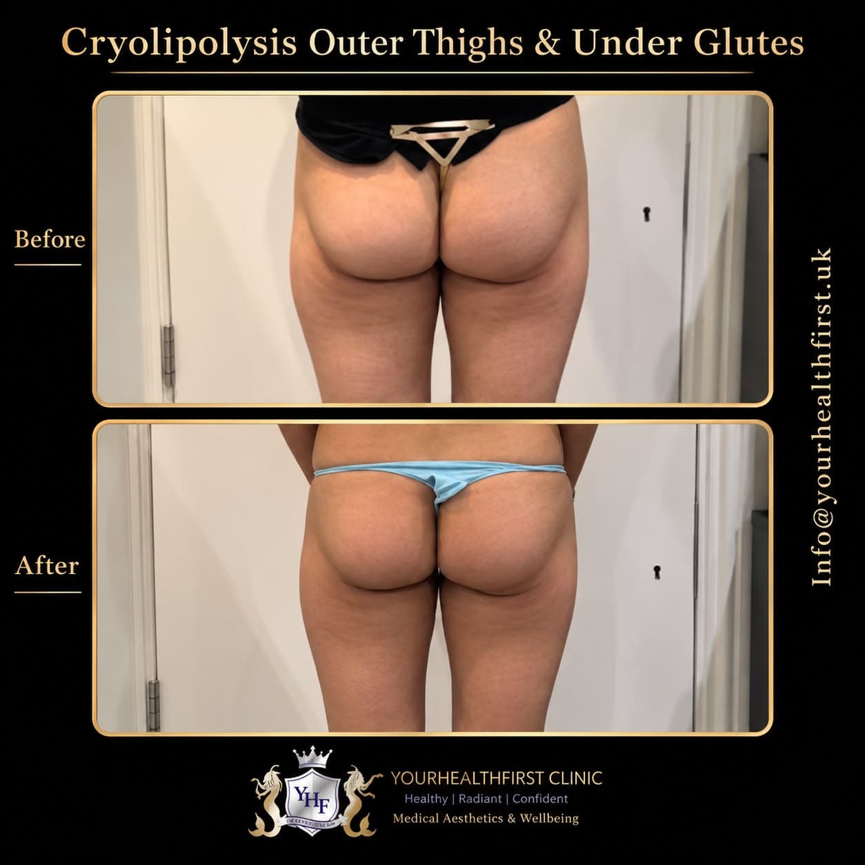 Cryolipolysis before & after — result 19