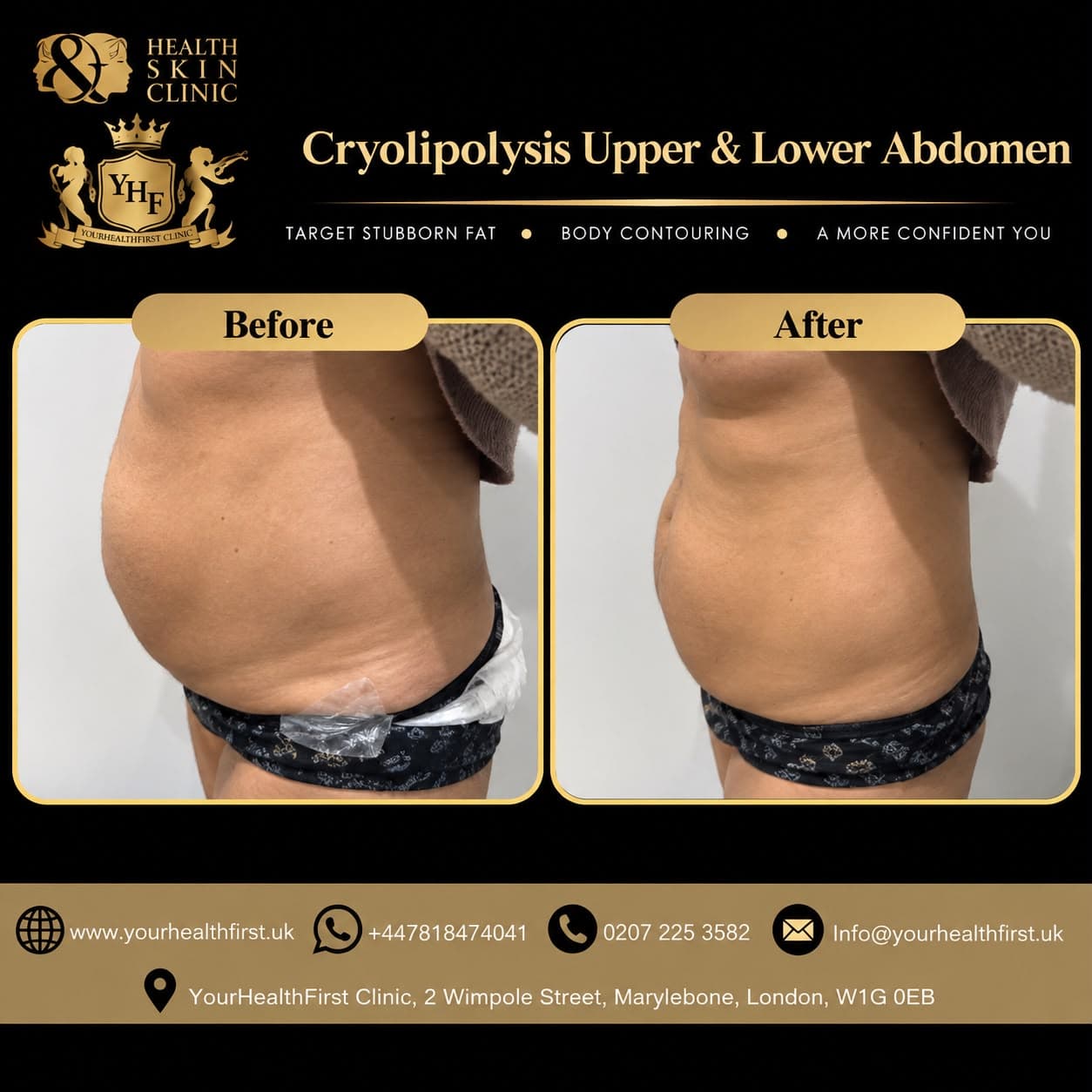 Cryolipolysis before & after — result 4