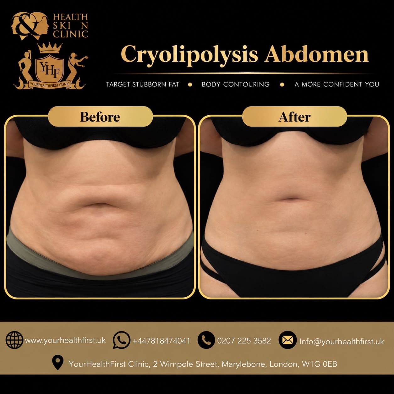 Cryolipolysis before & after — result 5