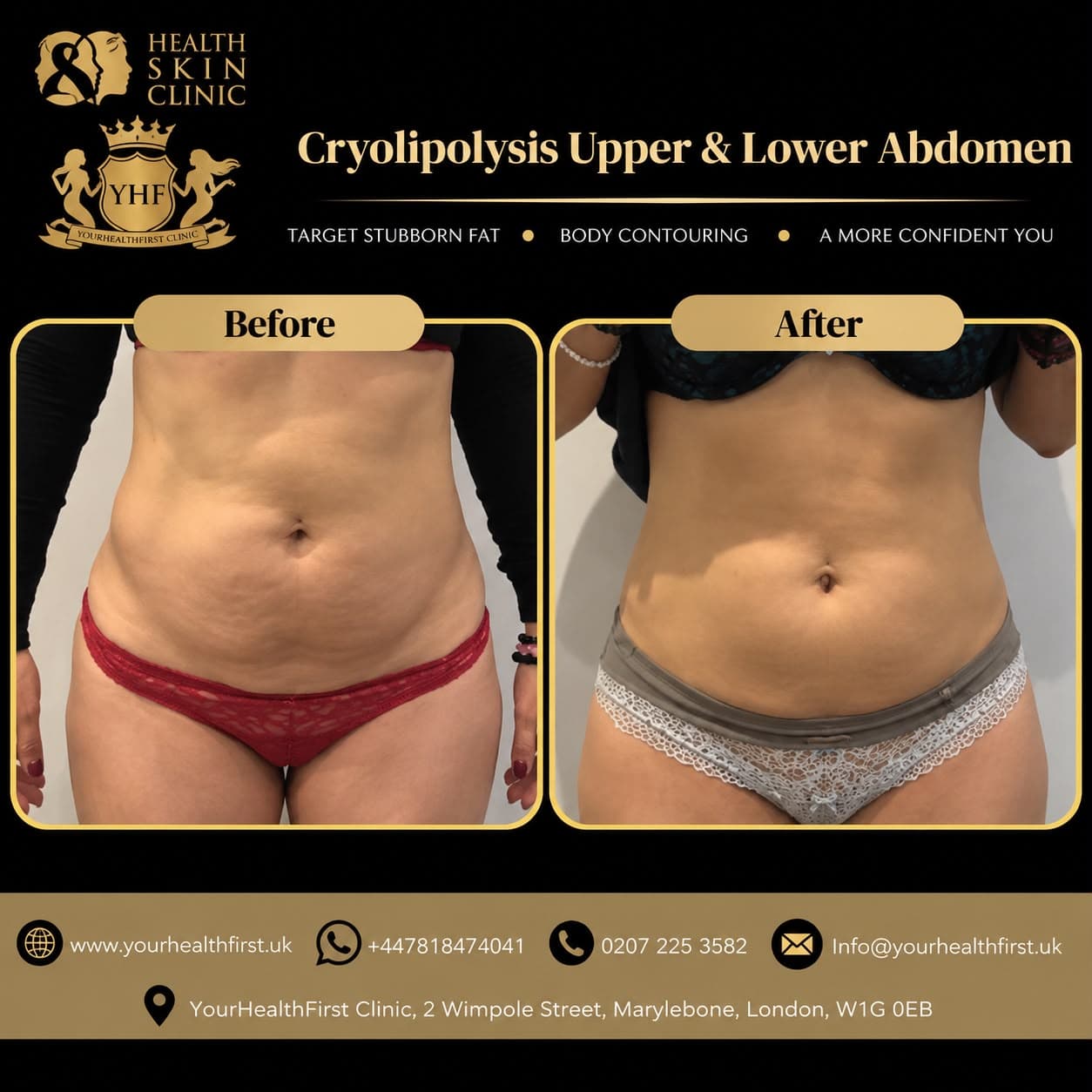 Cryolipolysis before & after — result 6
