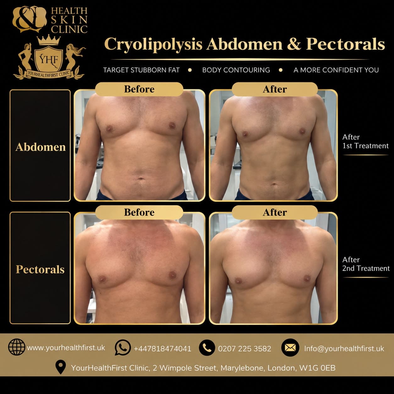 Cryolipolysis before & after — result 7