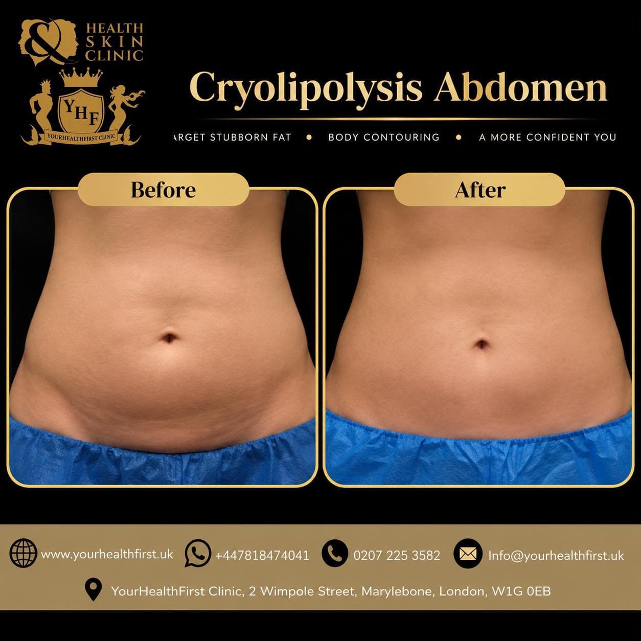 Cryolipolysis before & after — result 8