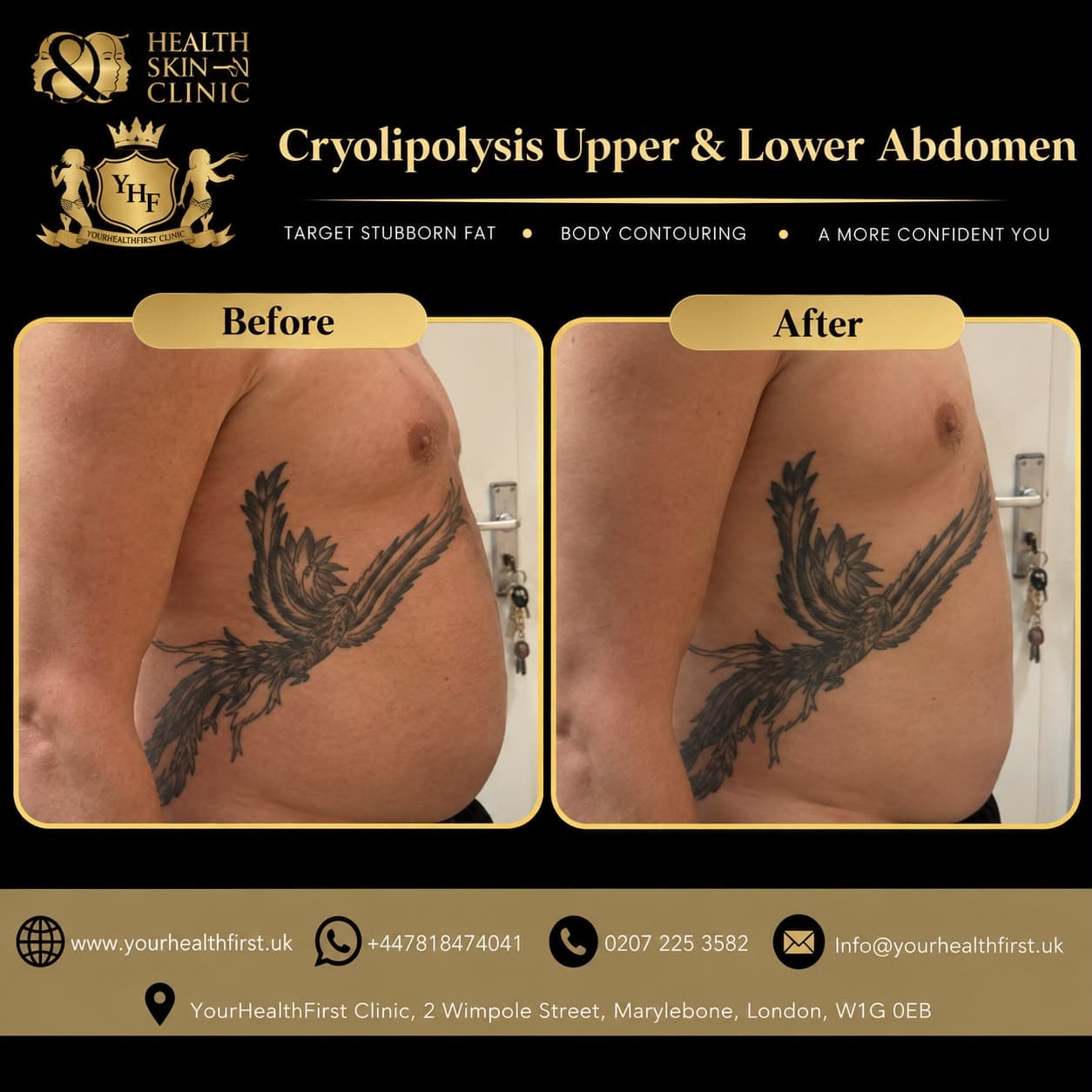 Cryolipolysis before & after — result 9