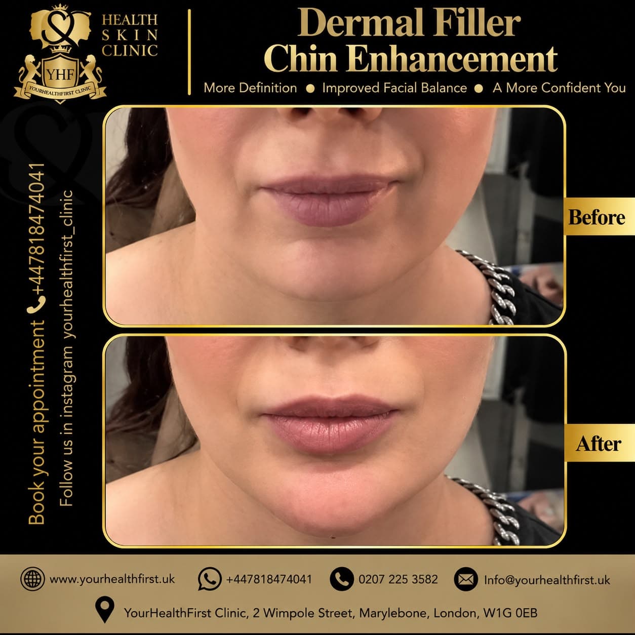 Dermal Fillers before & after — result 1