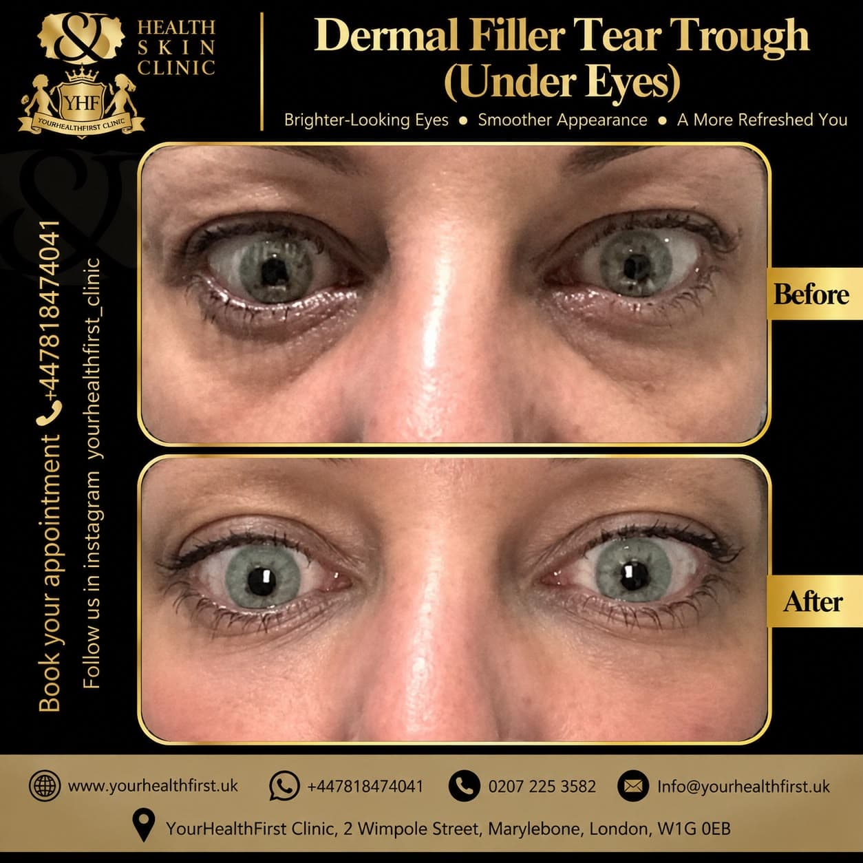 Dermal filler before & after — result 10