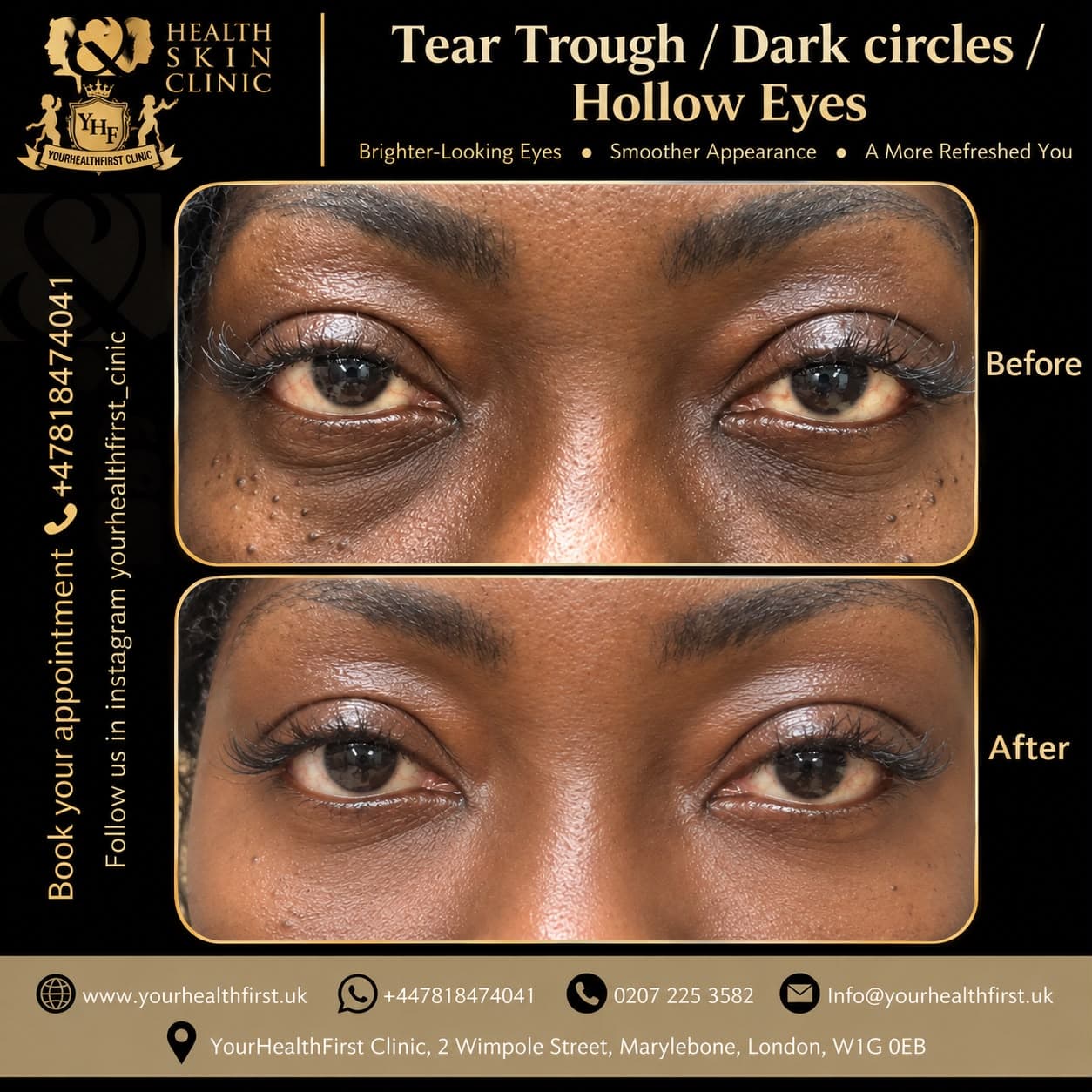 Dermal filler before & after — result 11