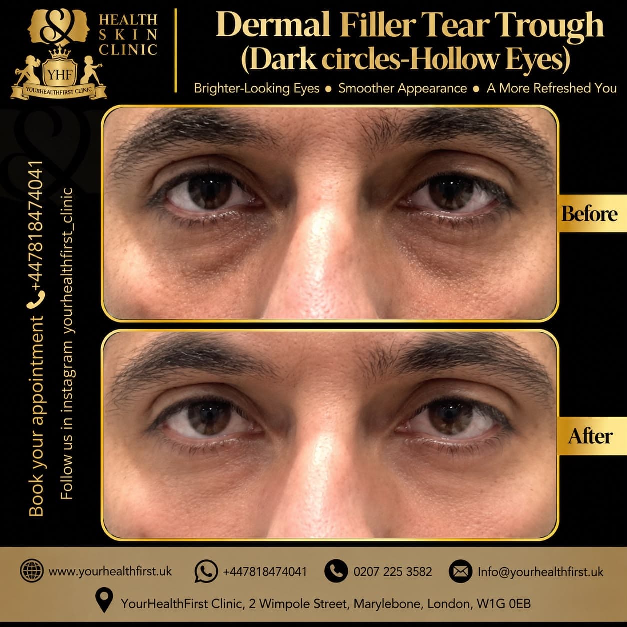 Dermal filler before & after — result 12