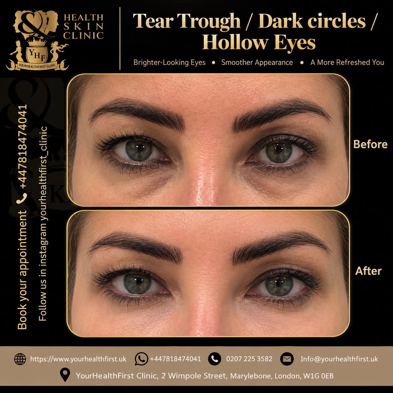 Dermal filler before & after — result 13