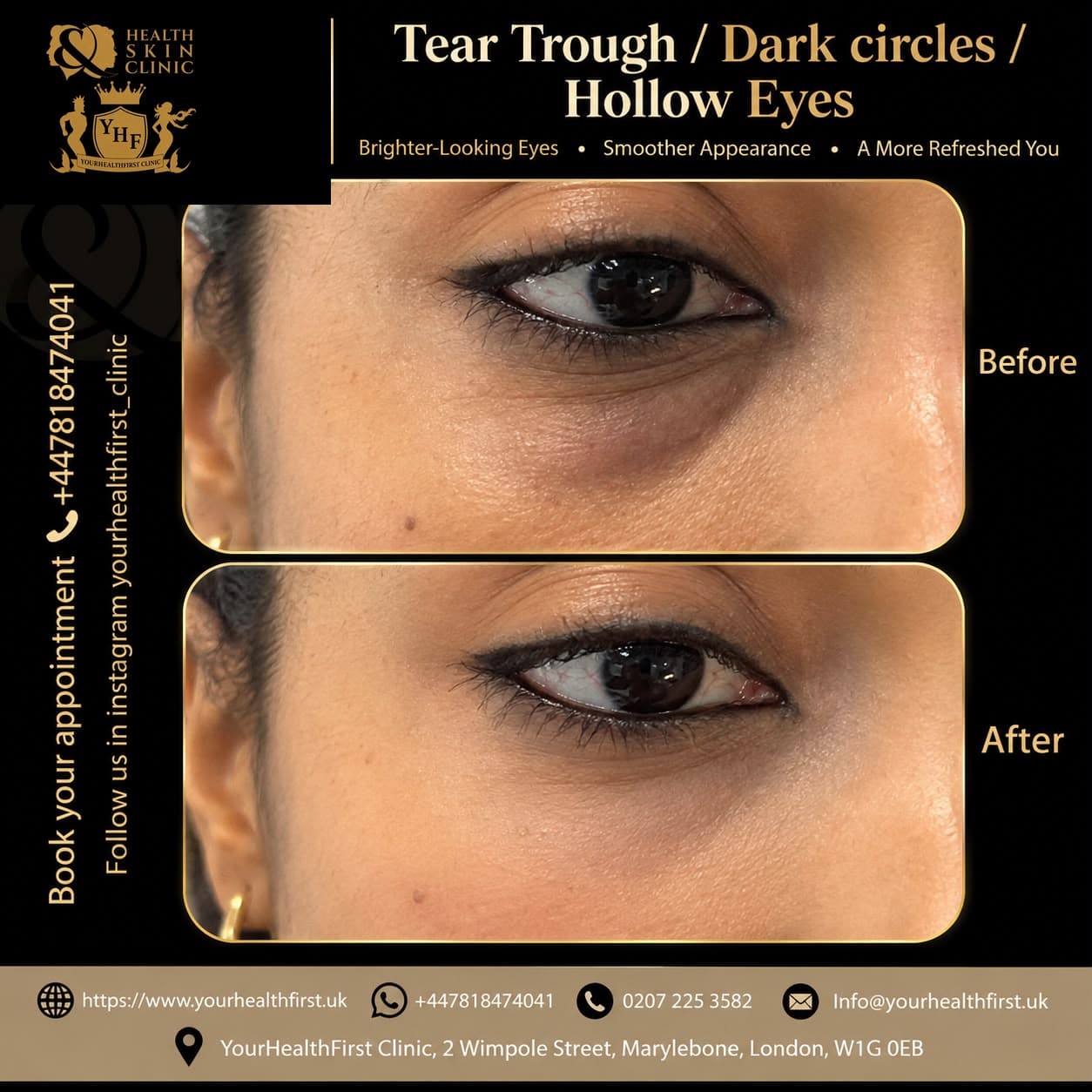 Dermal filler before & after — result 14