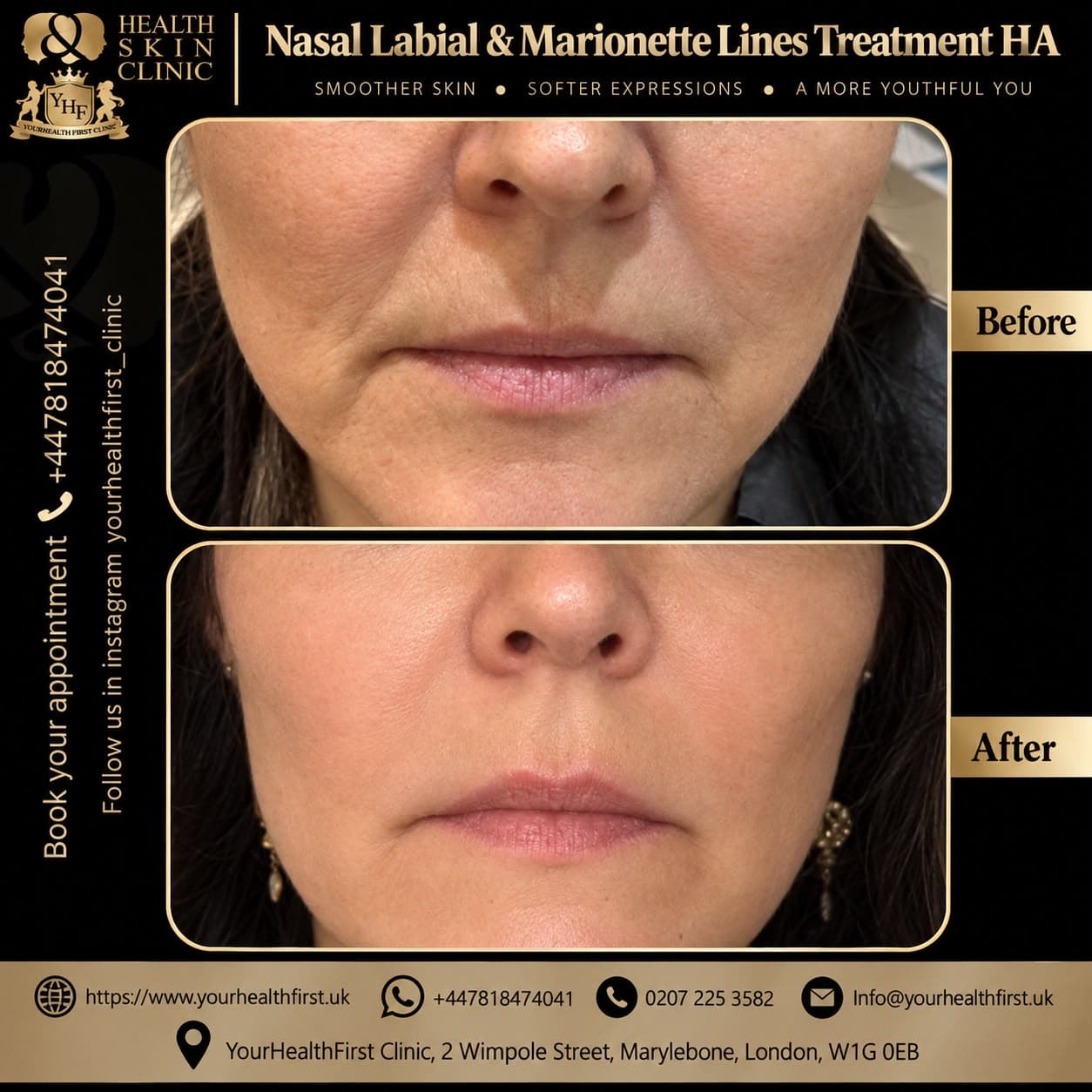 Dermal Fillers before & after — result 2