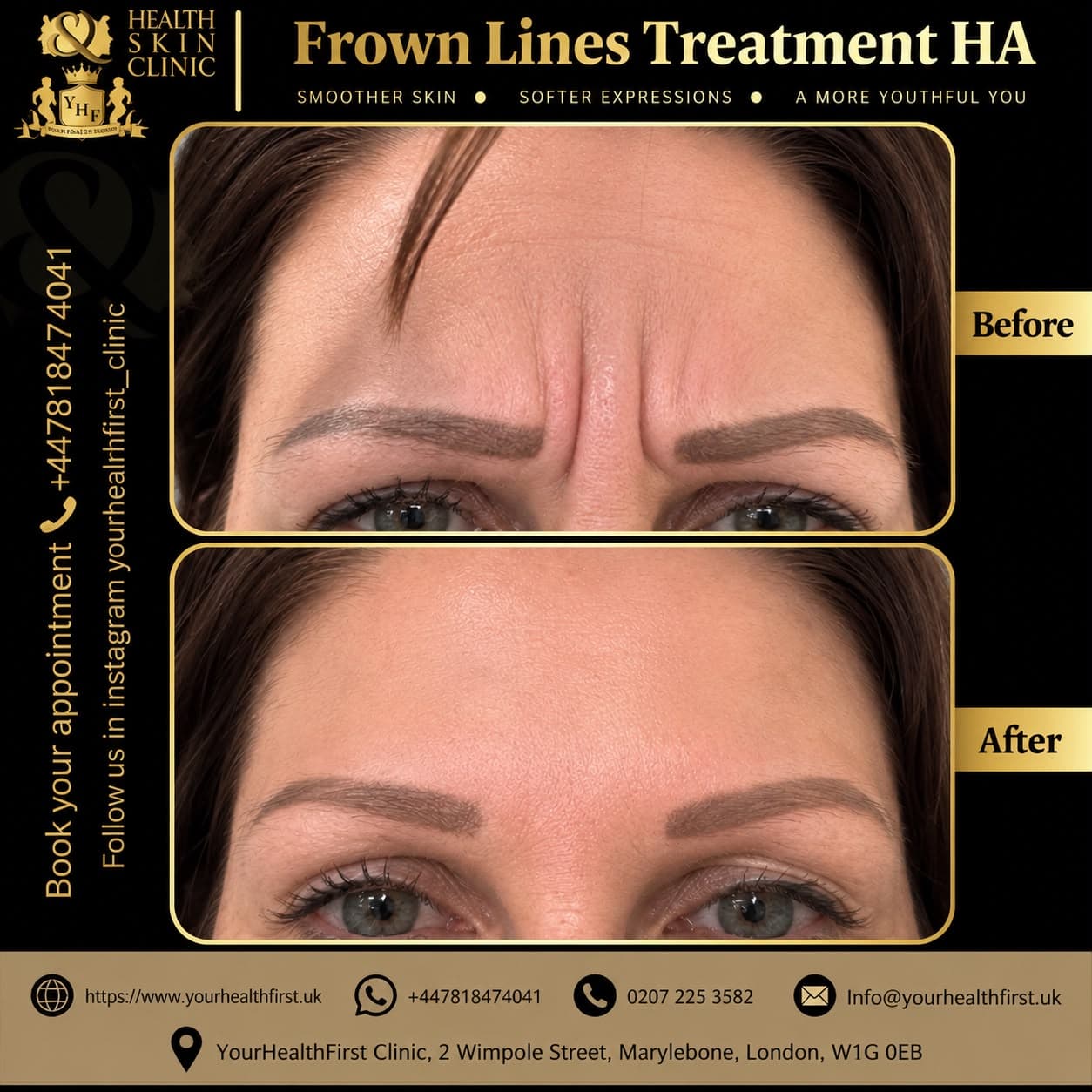 Dermal Fillers before & after — result 3