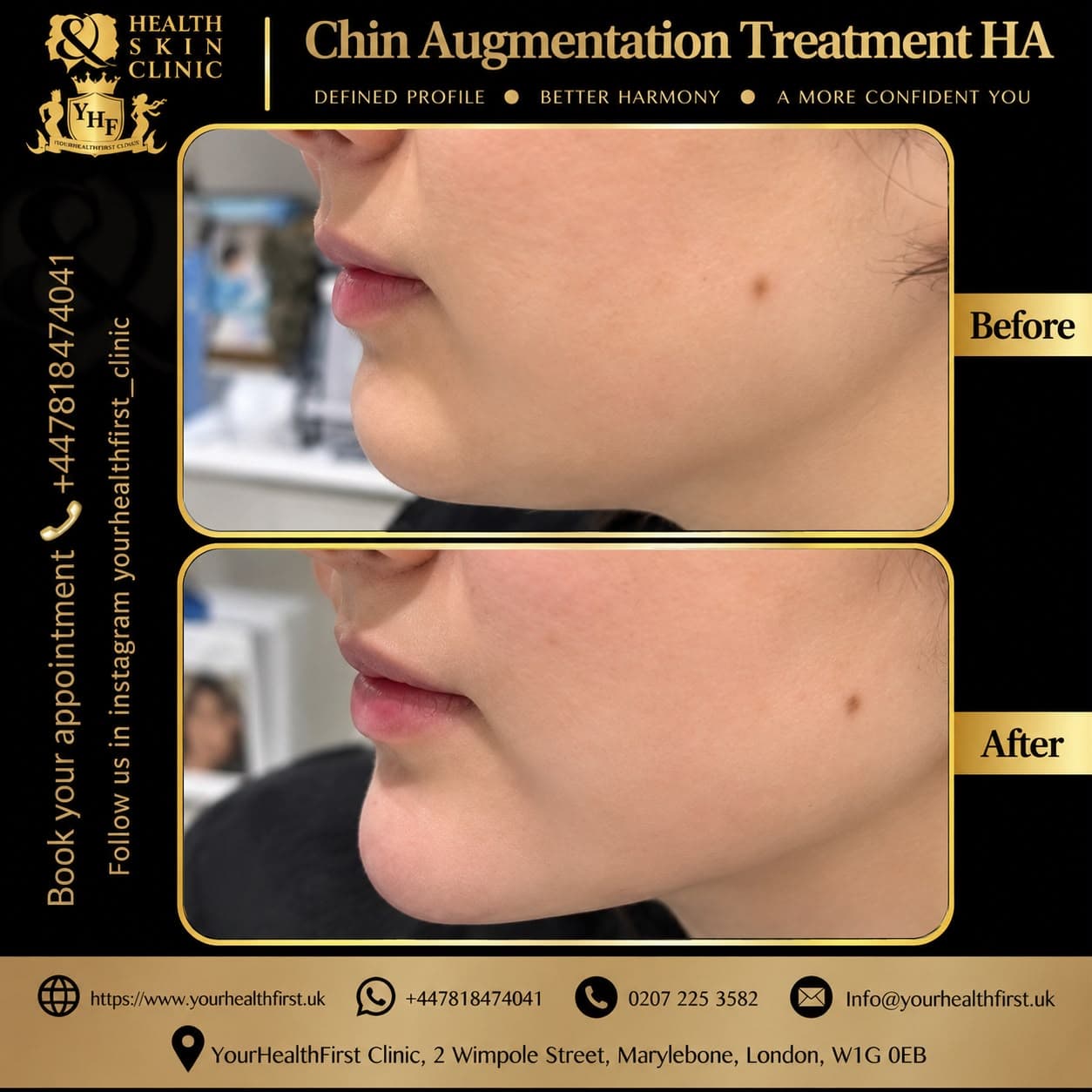 Dermal filler before & after — result 4