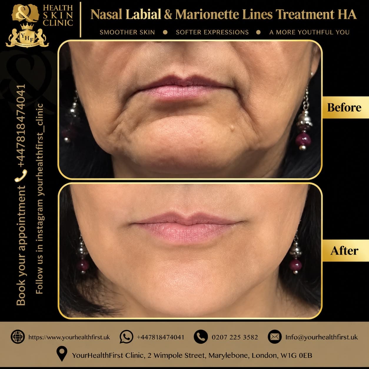 Dermal filler before & after — result 5