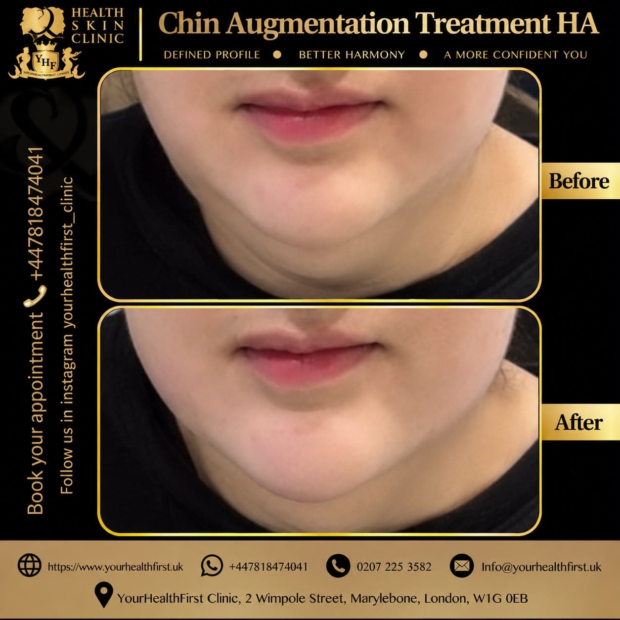Dermal filler before & after — result 6