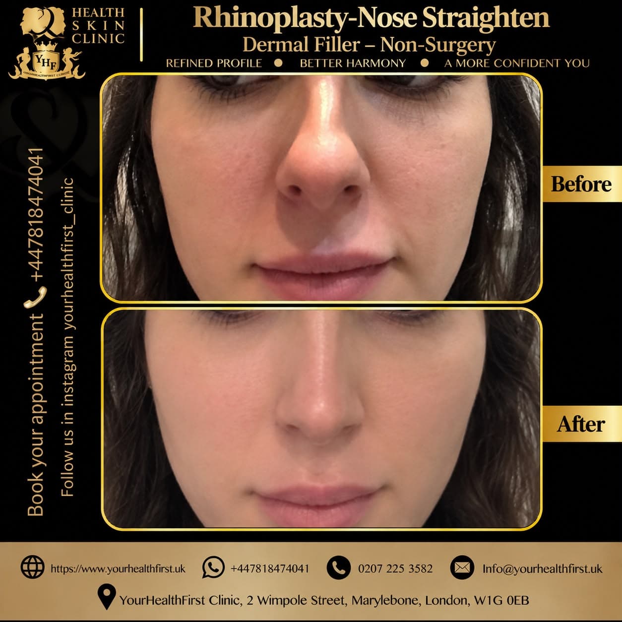 Dermal filler before & after — result 7