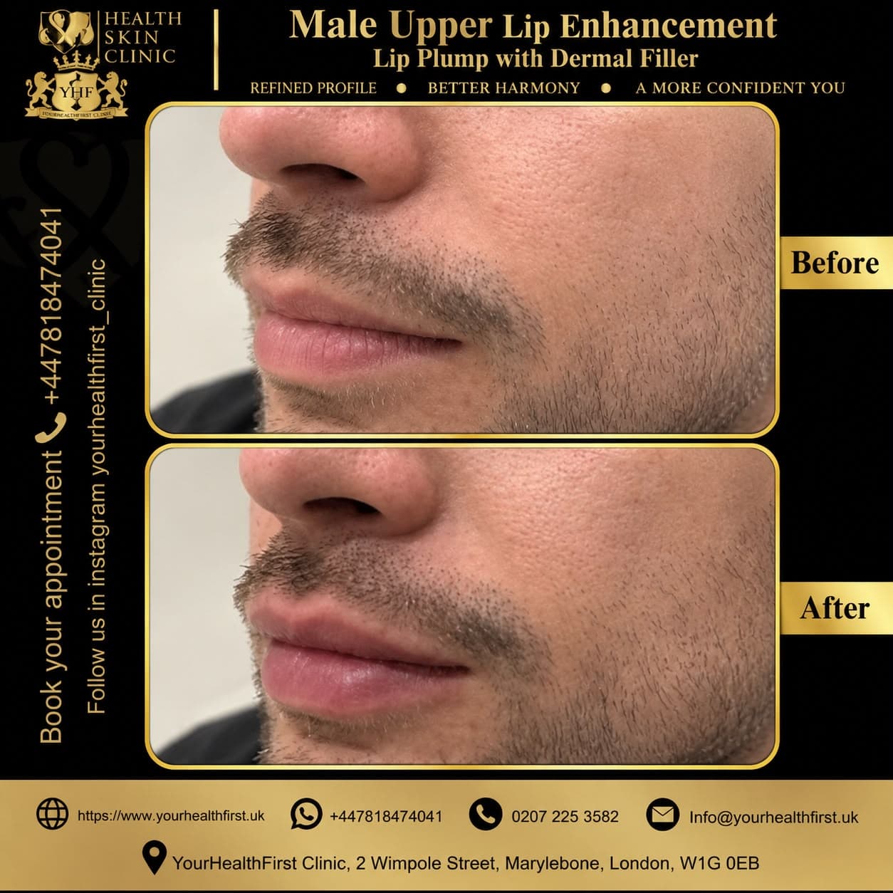 Dermal filler before & after — result 8