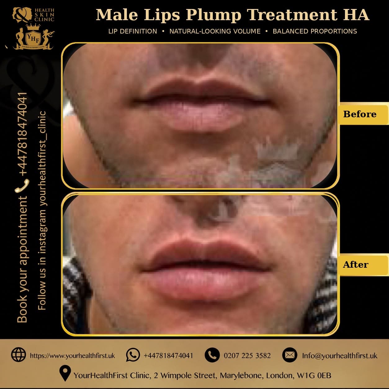 Dermal filler before & after — result 9