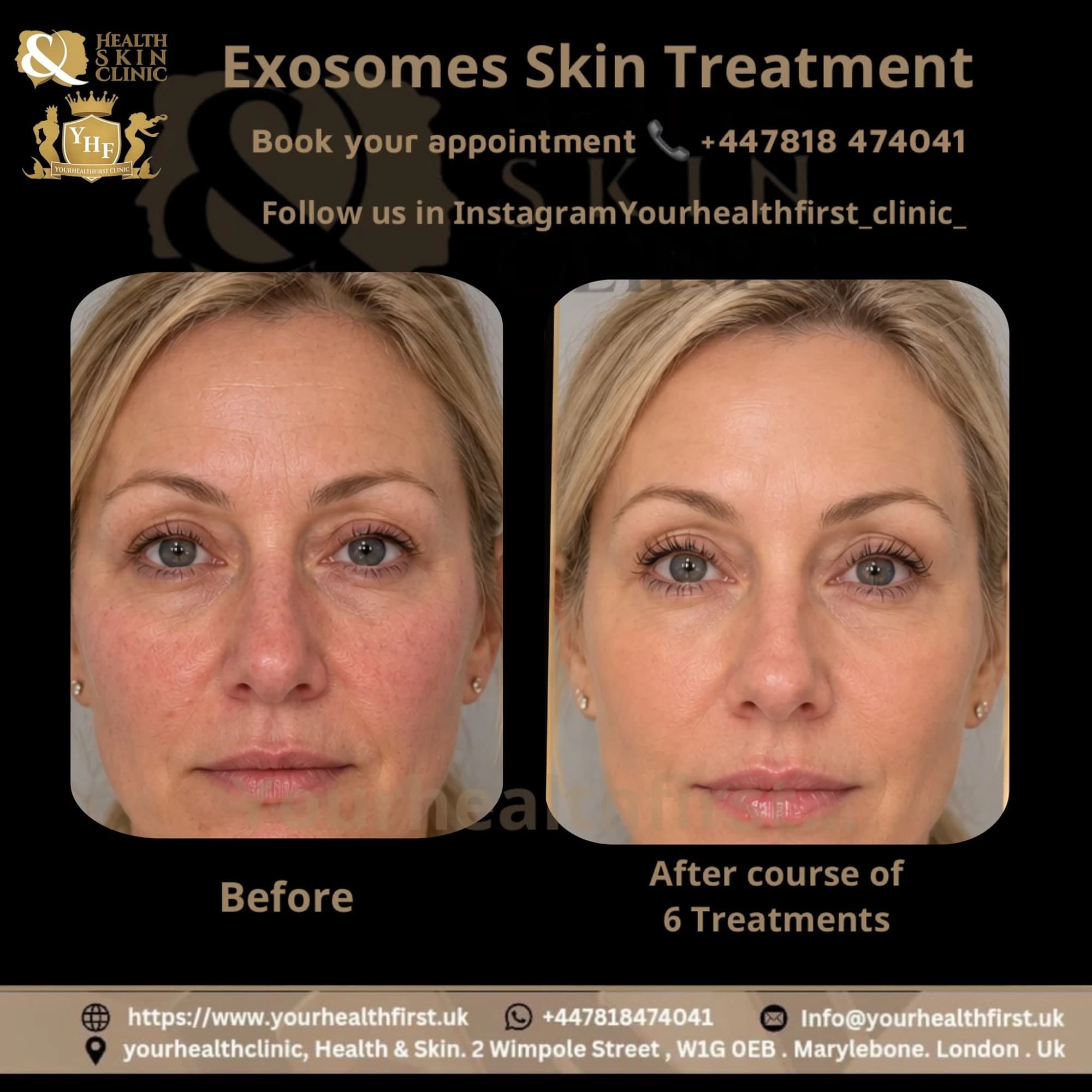 EXO OX exosome therapy before & after — result 4