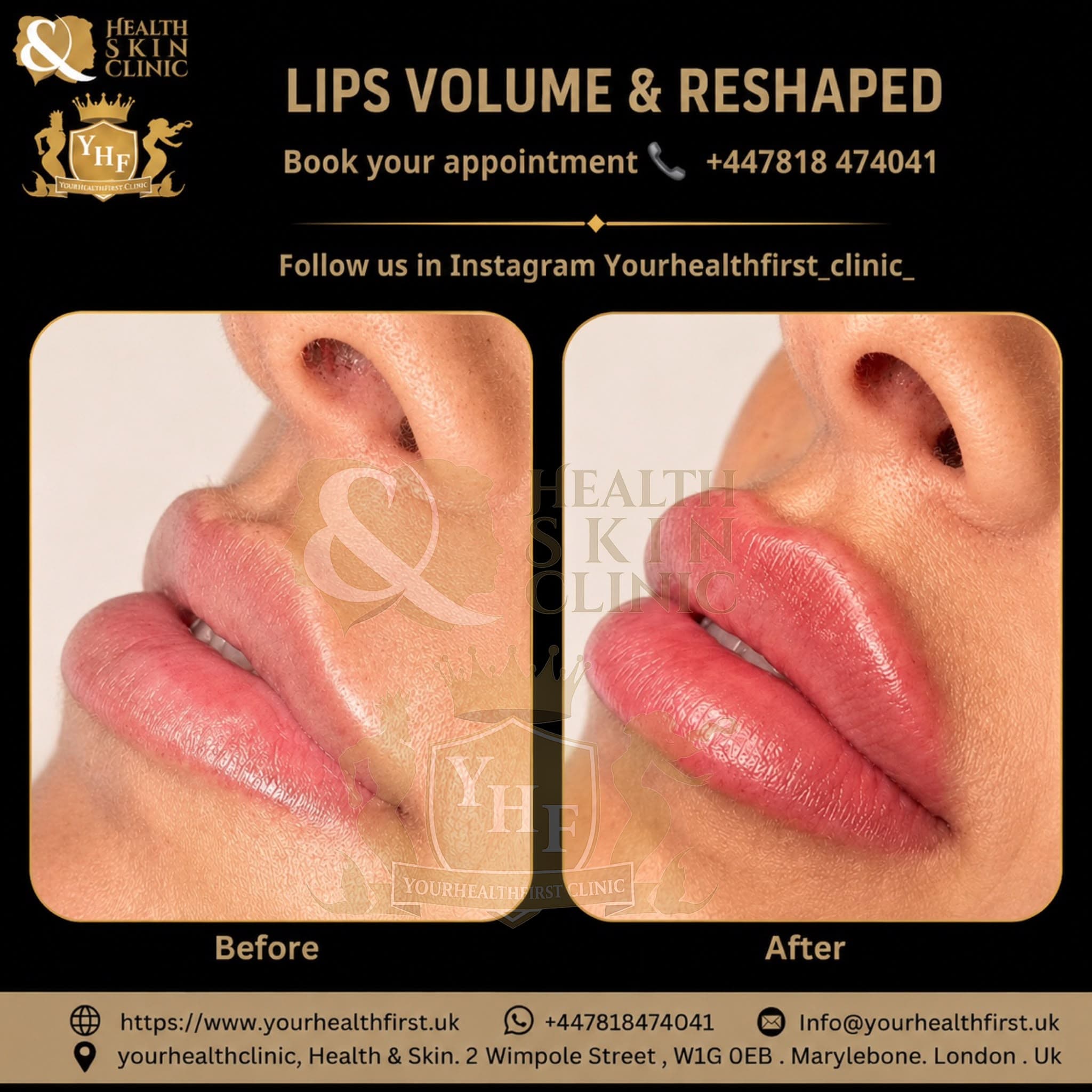 Lip fillers before & after — result 1