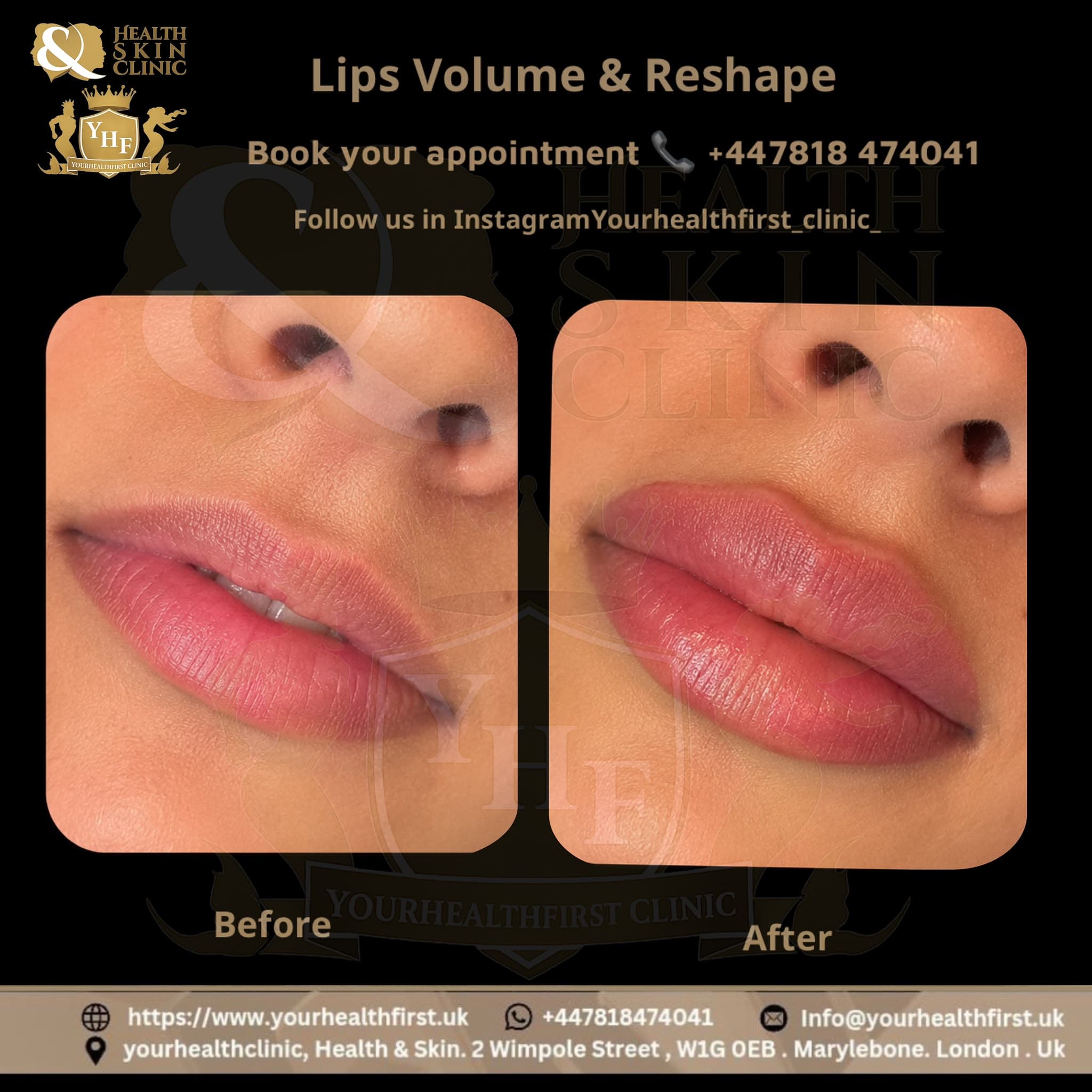 Lip fillers before & after — result 2