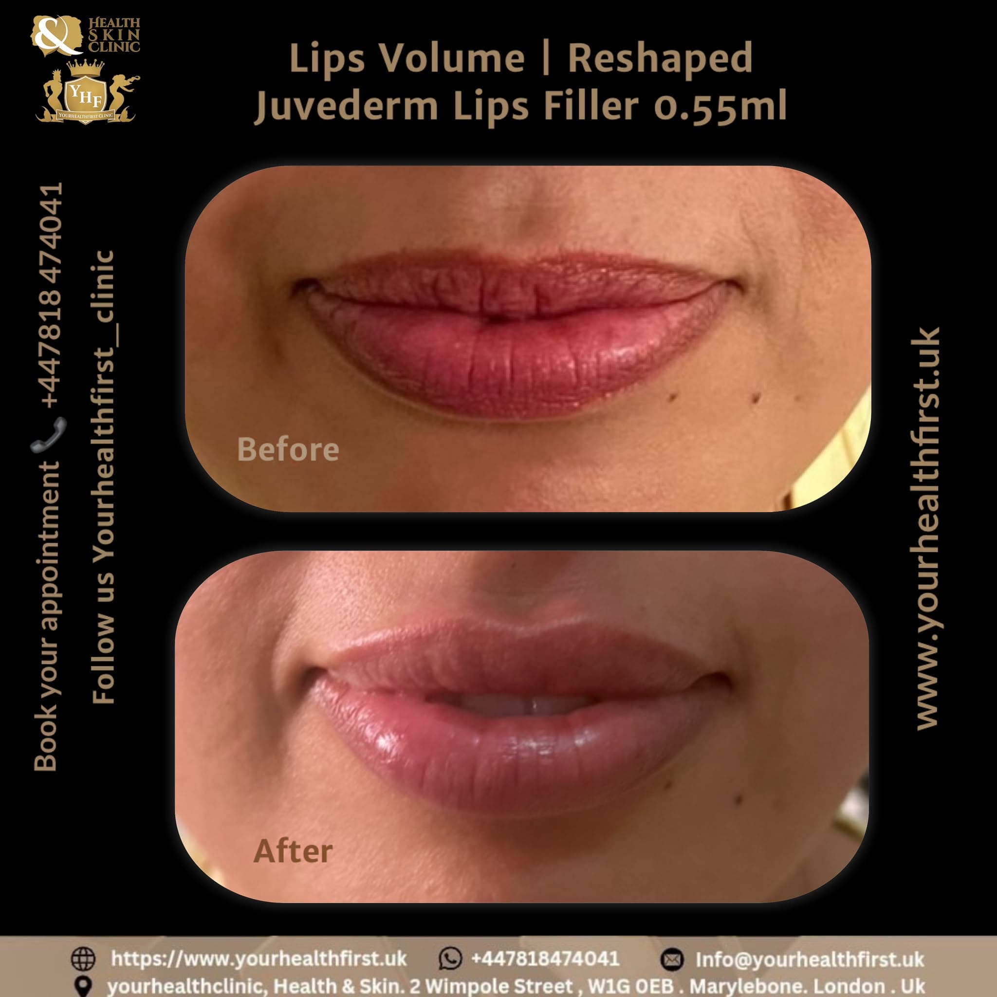 Lip fillers before & after — result 3