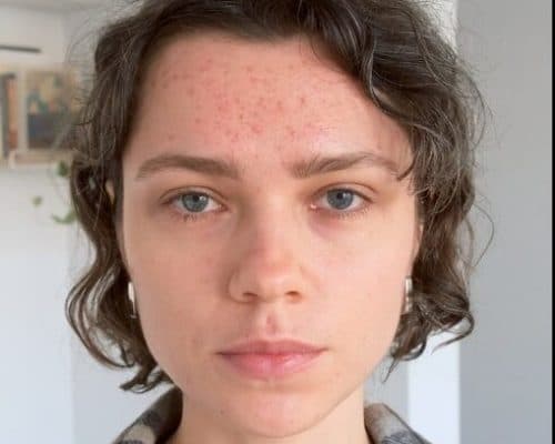 Microneedling — before