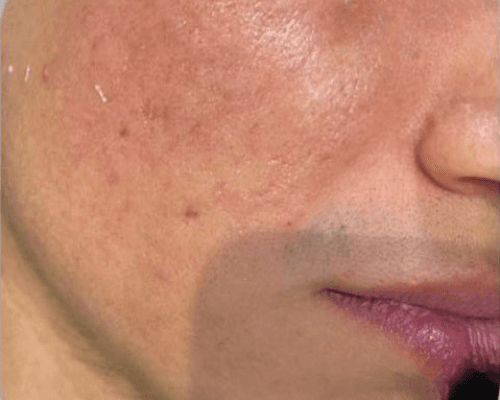 Microneedling — after
