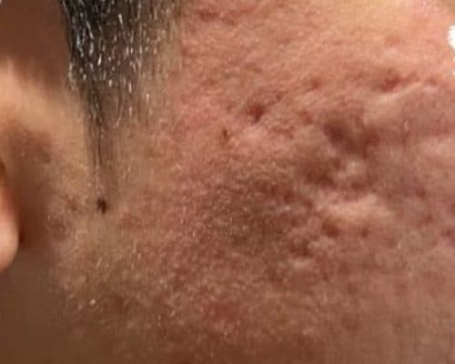 Microneedling — before